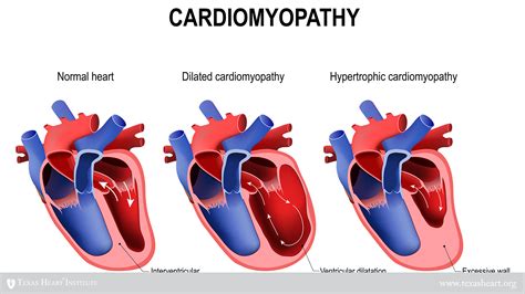 concentric lvh mild|life expectancy hypertrophic cardiomyopathy.